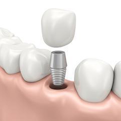 Candidate for Dental Implants in Apex, NC?