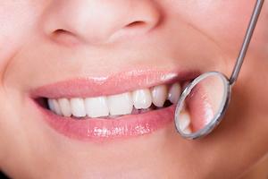 Close up of patients smile being examined for dental fillings in Apex NC