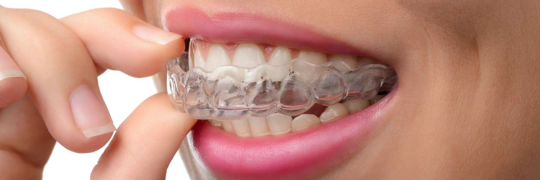 Invisible Braces