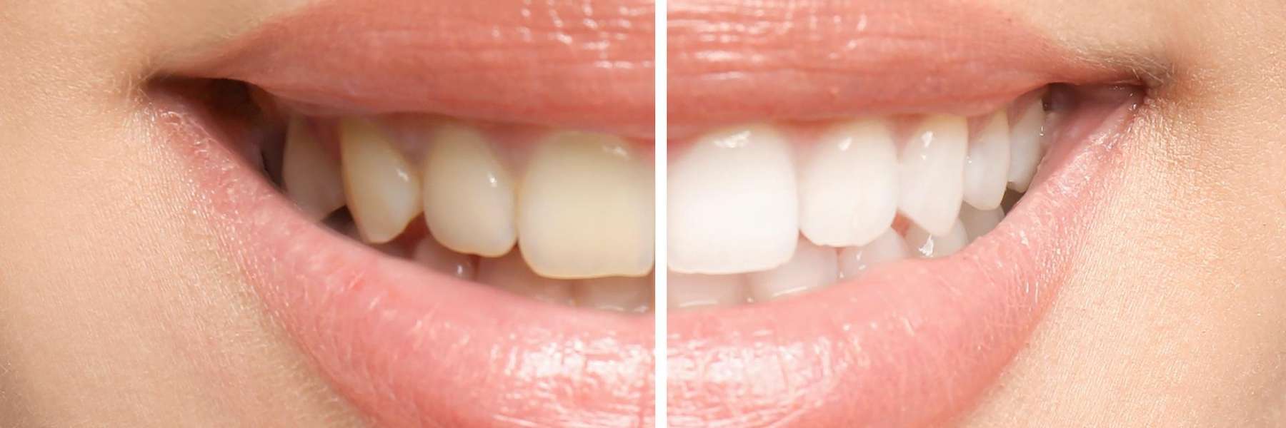 Safe, Effective, and Efficient Professional Teeth Whitening in Apex, NC