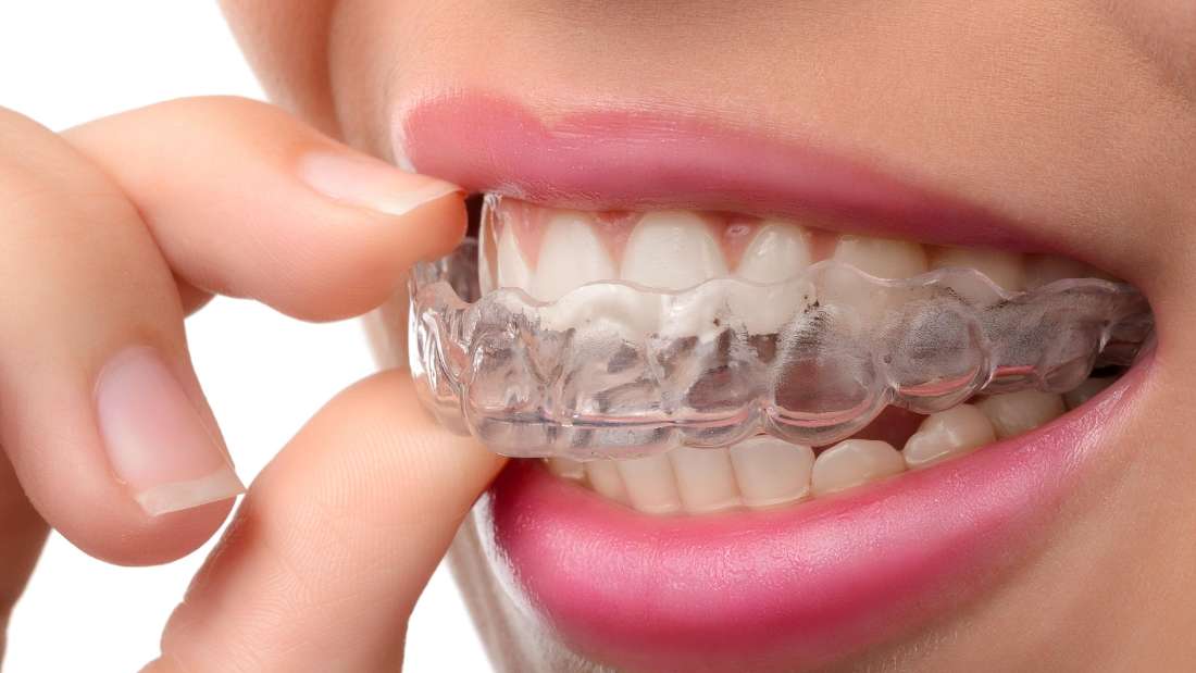Get Invisalign Clear Braces Apex Olive Chapel Dentistry