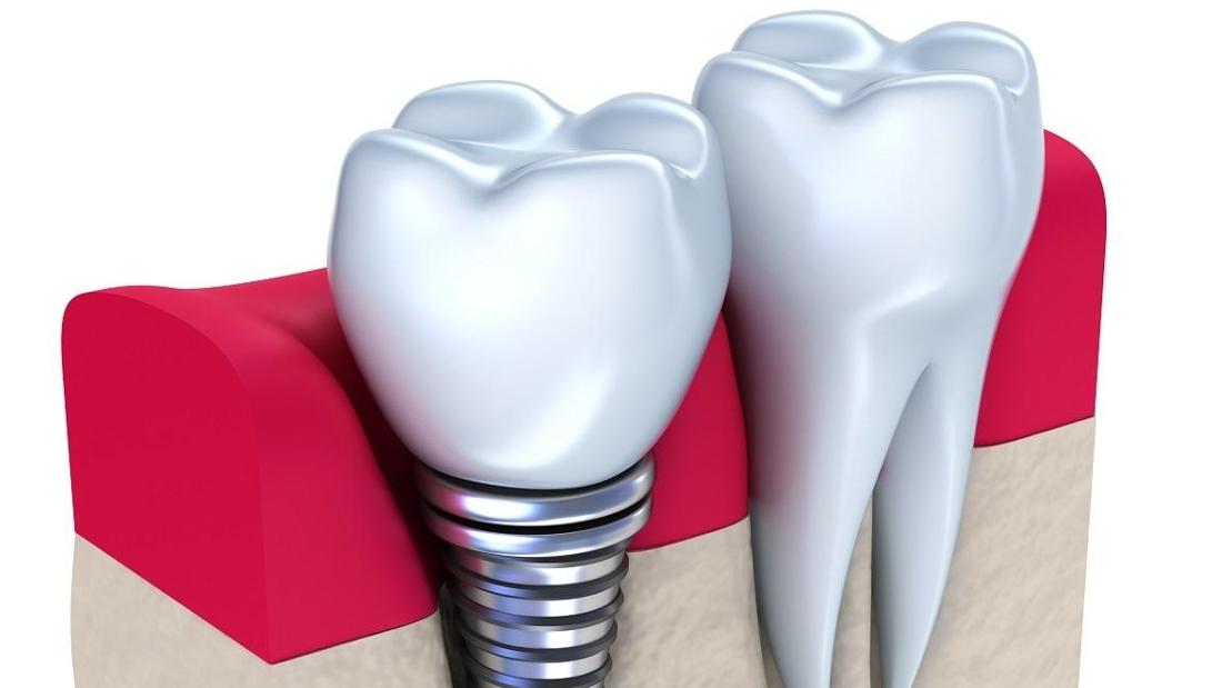 Dental Implant Procedure Apex Blog Dr Dustin Prusik DDS
